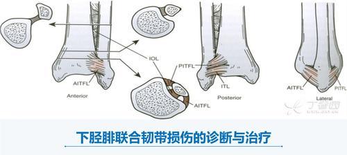 韧带拉伤的正确处理方式（有效预防和快速康复）